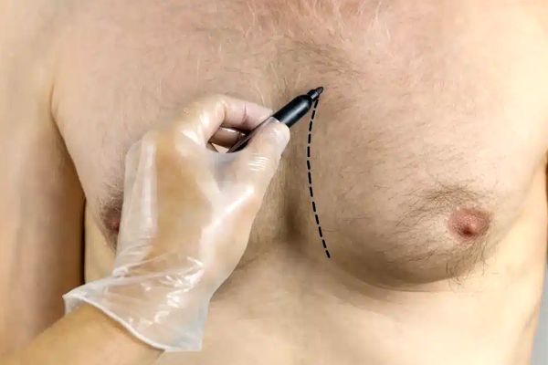 آشنایی با علت های بیماری ژنیکوماستی در مردان