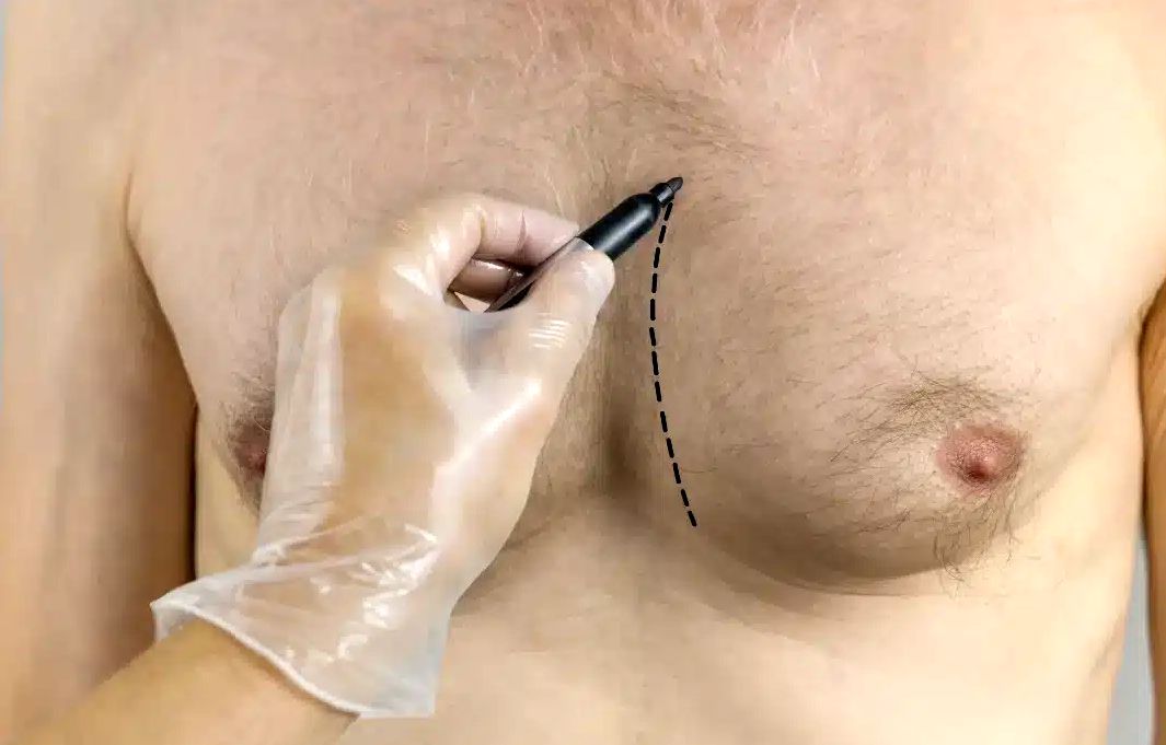 آشنایی با علت های بیماری ژنیکوماستی در مردان