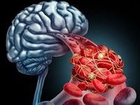 کاهش سن سکته مغزی در ایران؛ زنگ خطری برای سلامت جامعه