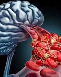 کاهش سن سکته مغزی در ایران؛ زنگ خطری برای سلامت جامعه