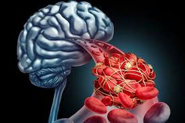 کاهش سن سکته مغزی در ایران؛ زنگ خطری برای سلامت جامعه